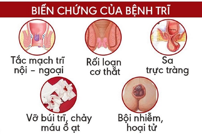 bệnh trĩ bệnh trĩ