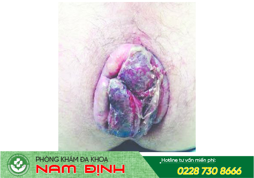 cắt trĩ cắt trĩ