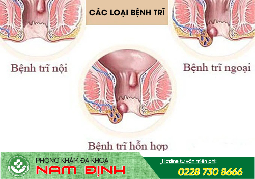 bệnh hậu môn bệnh hậu môn