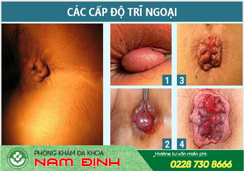 bệnh trĩ bệnh trĩ