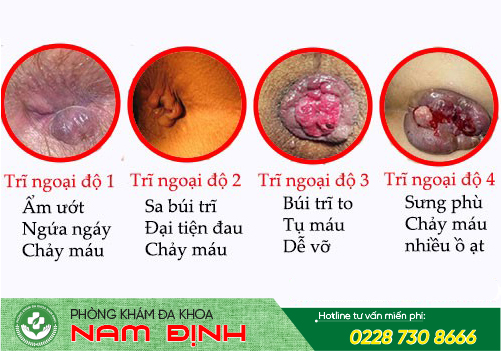 trĩ ngoại trĩ ngoại