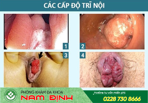 bệnh trĩ bệnh trĩ