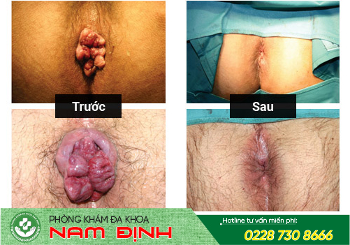 bệnh trĩ bệnh trĩ