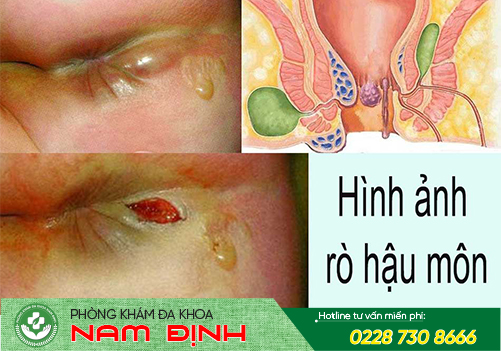 bệnh hậu môn bệnh hậu môn