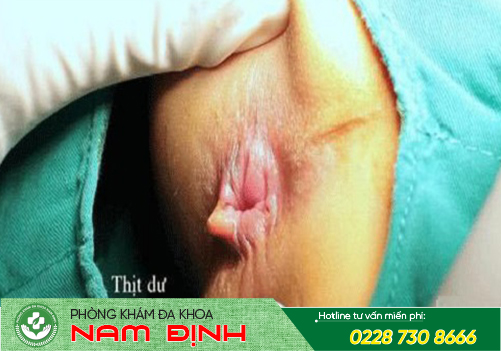bệnh hậu môn bệnh hậu môn