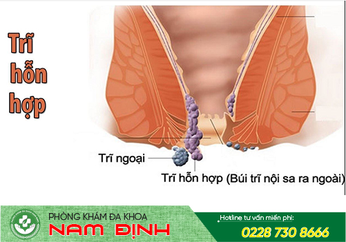 trĩ hỗn hợp trĩ hỗn hợp